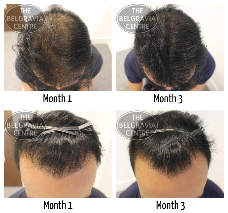 regrow hair around hairline